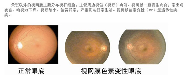 叶黄素对改善视网膜色素变性的视觉灵敏度和对比敏感度有显著效果